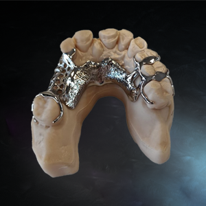 dental frame 3d printed with e dur